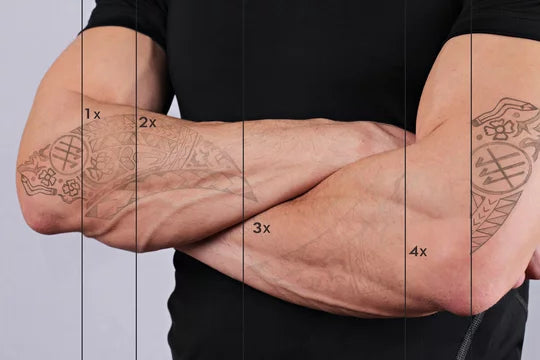 Tatoeage verwijderen Picolaser