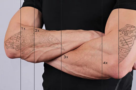 Tatoeage verwijderen Picolaser