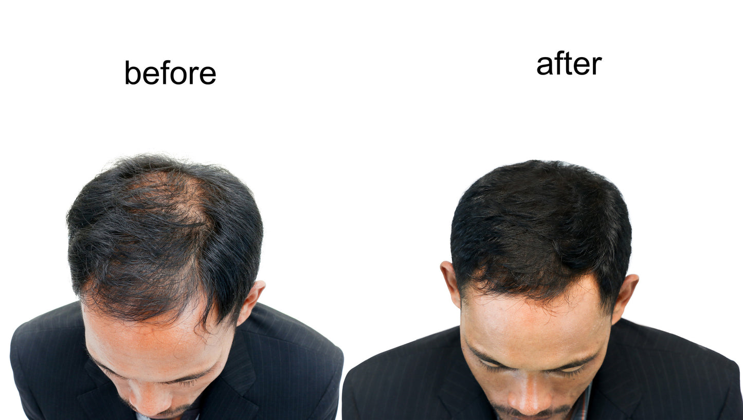 Haar & Baard Booster Therapie (Dermashot + Exosomen)