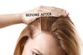 Haar Therapie (Dermashot + Exosomen)