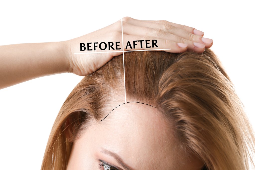 Haar Therapie (Dermashot + Exosomen)