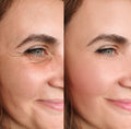 BTX Therapy (Glass skin)