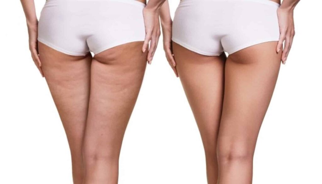Cellulite behandeling