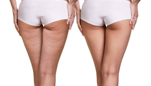 Cellulite behandeling