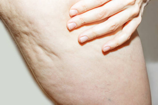 Cellulite behandeling