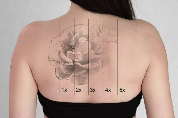 Professioneel Tatoeage Verwijderen