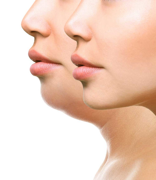 Vetoplossende Bodycontouring met de Dermashot
