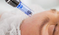 Microneedling
